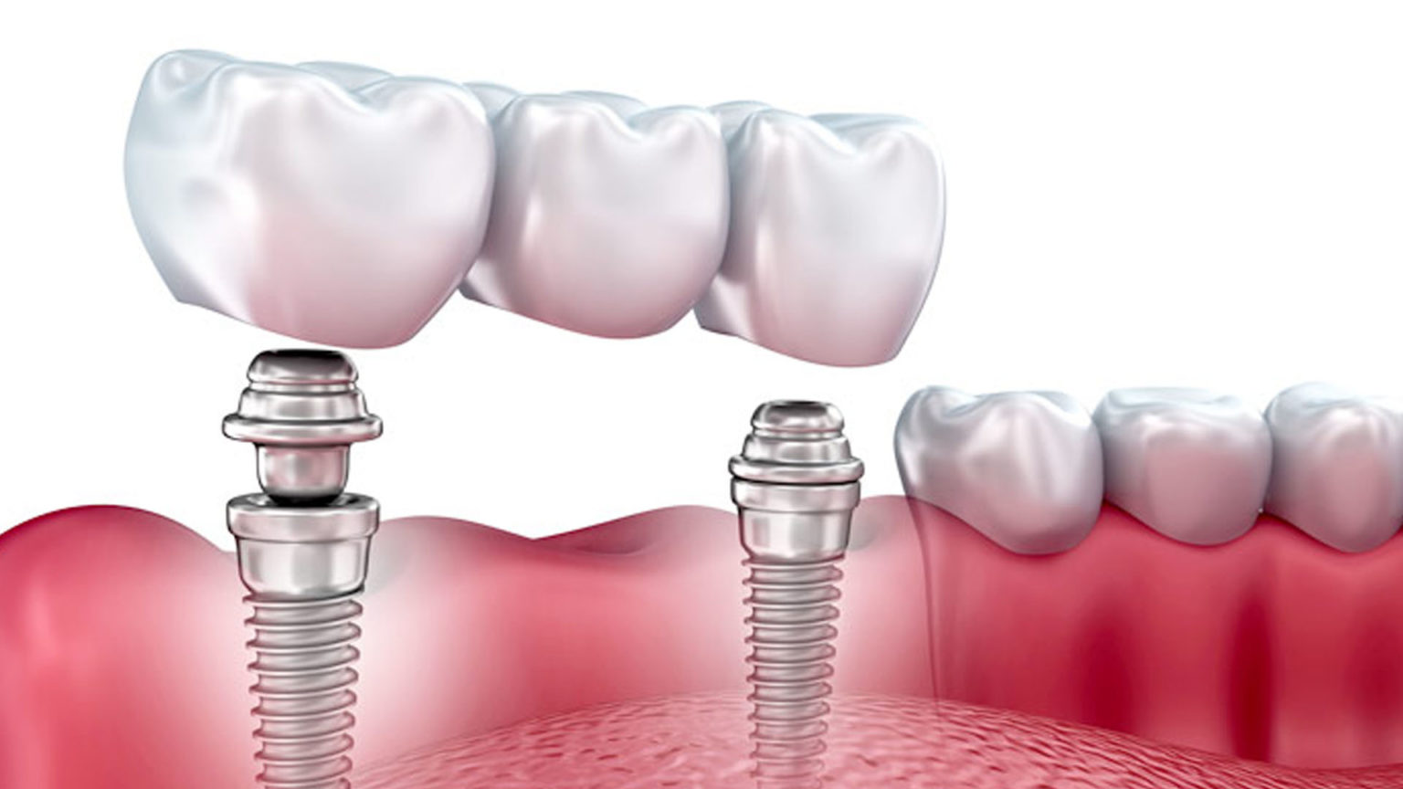 стоматологическая имплантация зубов