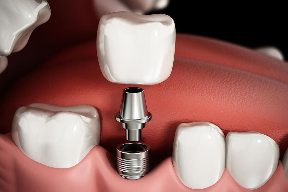 dental implants in Newmarket