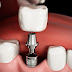The Benefits of Dental Implants 