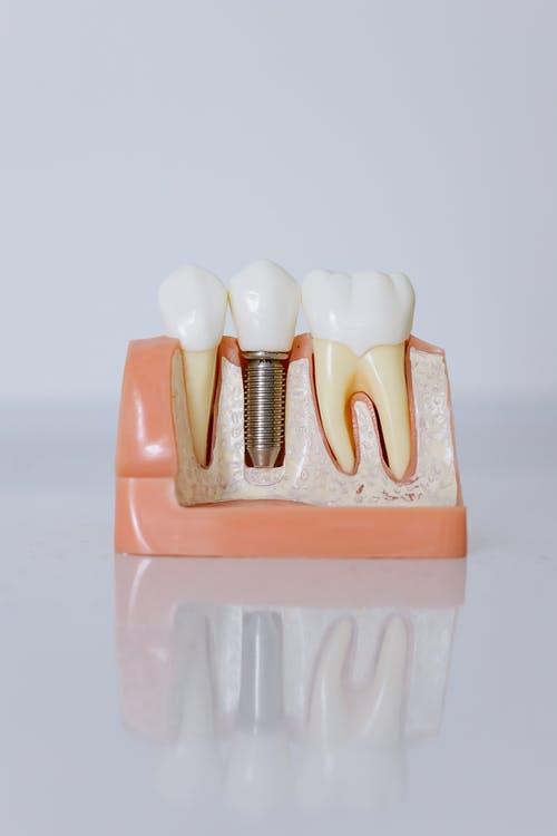 Free Close-Up Shot of Dental Implant Model Stock Photo