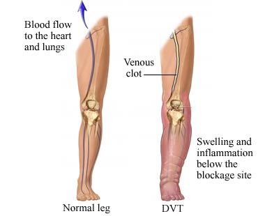 venous clots prevent blood flow to the heart and lungs during pregnancy