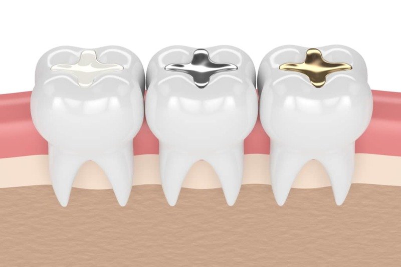 Nên chọn vật liệu hàn răng phù hợp với tình trạng răng miệng