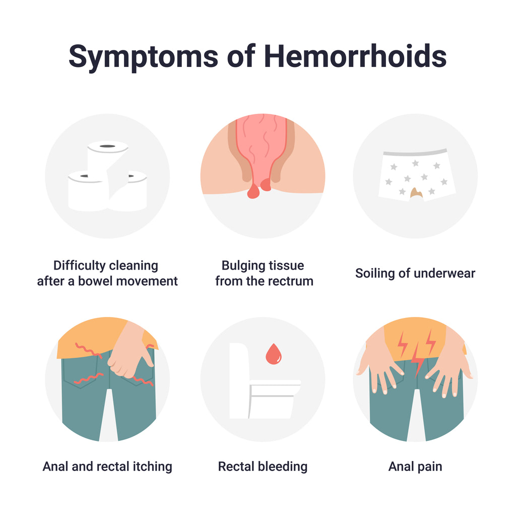Understanding the Triggers for Hemorrhoids Symptoms of Hemorrhoids