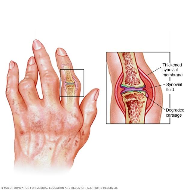 Rheumatoid arthritis - Symptoms and causes - Mayo Clinic