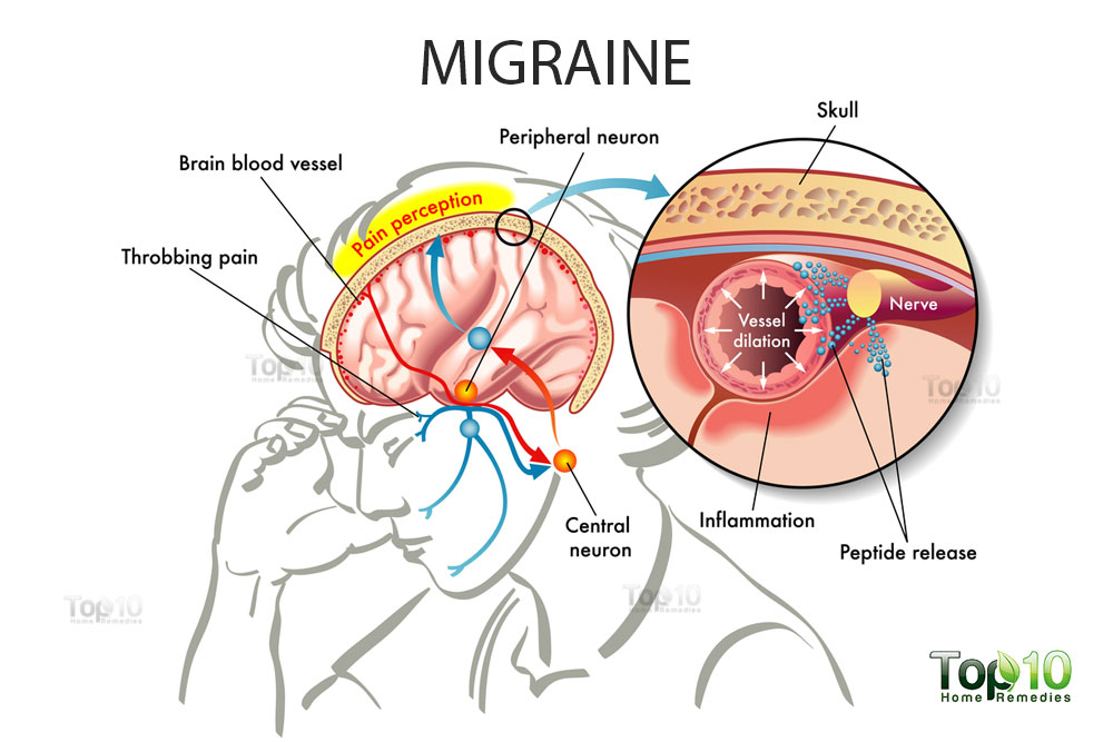 Migraine.jpg