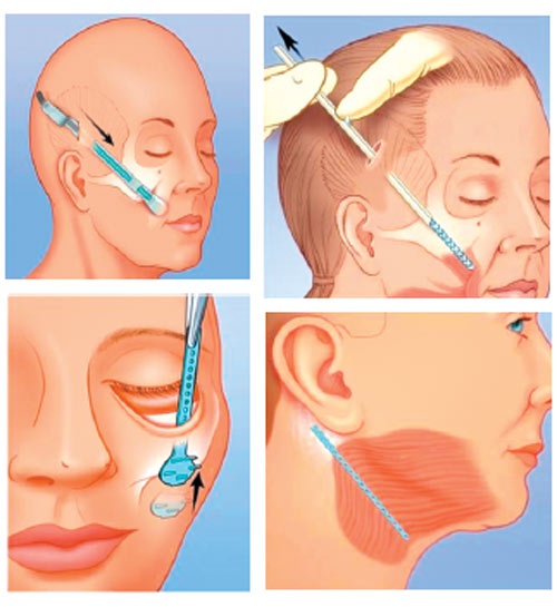 Căng da mặt nội soi là phương pháp phẫu thuật giúp hạn chế chùng nhão, nếp nhăn,... tại vùng da trên khuôn mặt, góp phần mang lại làn da trẻ trung, căng bóng như tuổi đôi mươi.