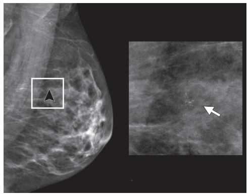  visão oblíqua médio-lateral de mamografia de rastreamento em mulher assintomática de 54 anos.