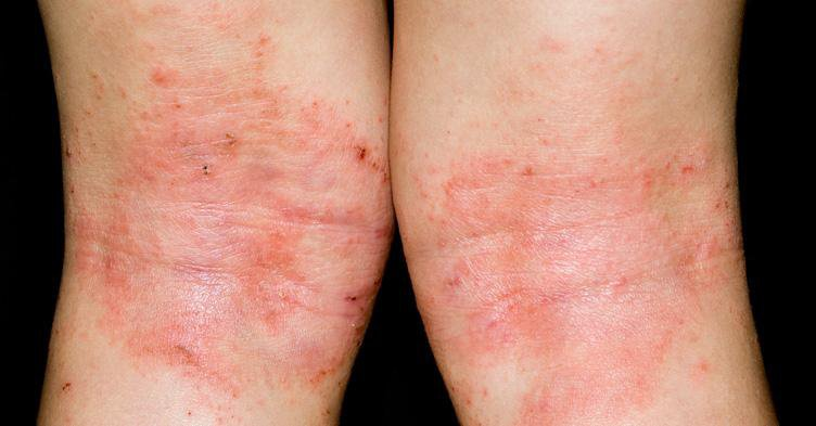 Bệnh chàm (Eczema) là gì? Nguyên nhân, triệu chứng và cách chữa