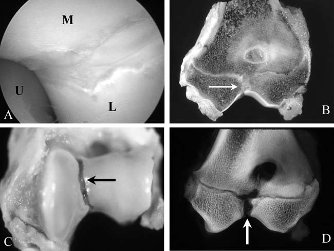A series of images illustrating incomplete ossification of the humeral condyle