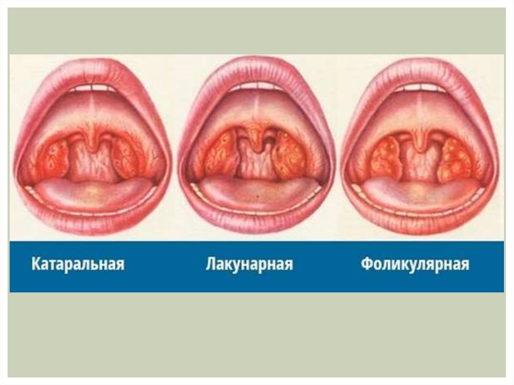 Самые эффективные антибиотики при ангине