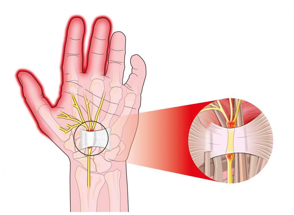 Hand Injury illustration
