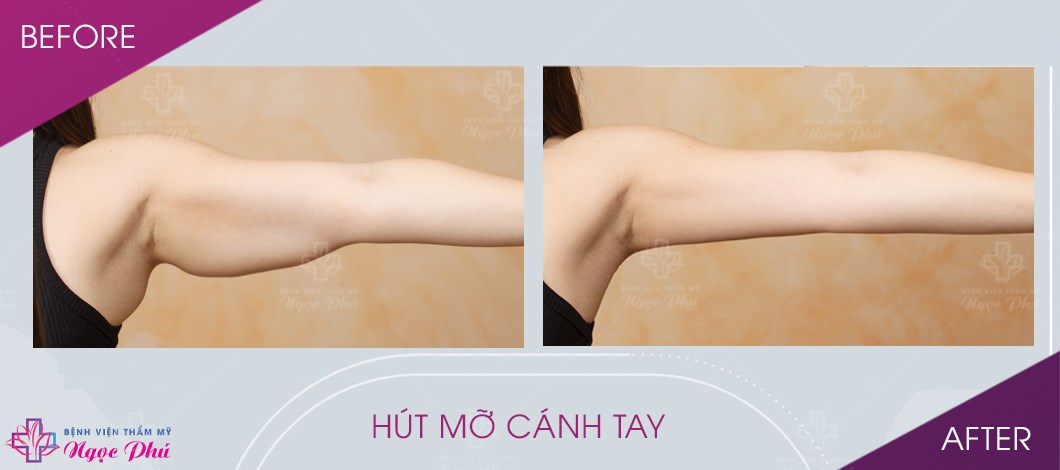 Phẫu thuật thẩm mỹ Ngọc Phú là địa chỉ làm đẹp top đầu đã thực hiện thành công hàng ngàn ca hút mỡ cánh tay, đem đến cho khách hàng một vóc dáng hoàn hảo nhất.