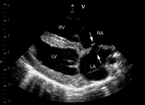 Four chamber view obtained from right parasternal window showing patent foramen ovale