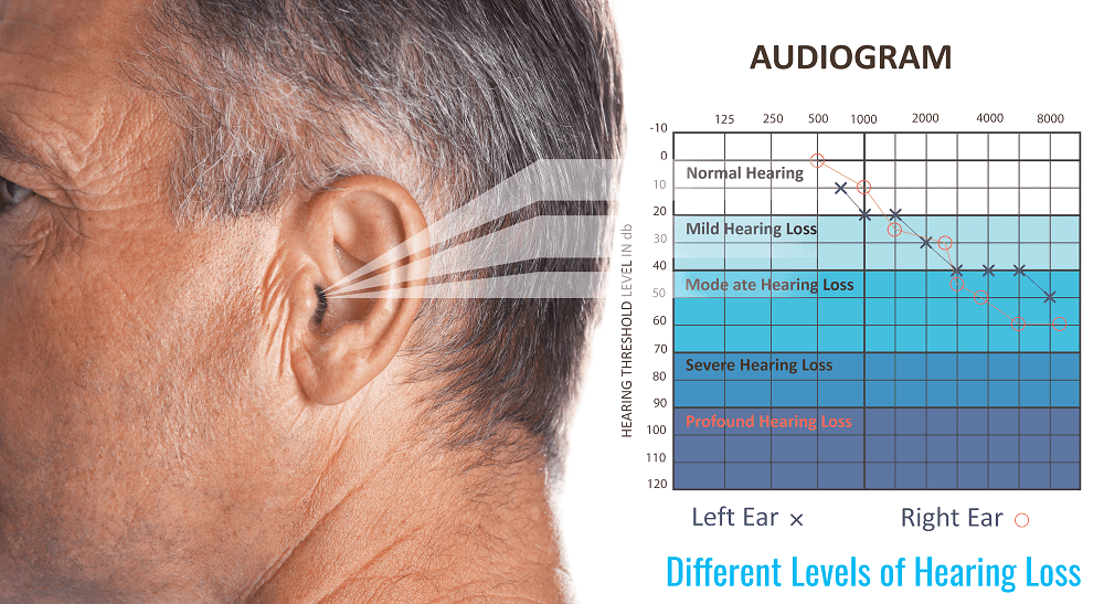 D:\Dilate\On board support\Oct Guest\Strategies for different levels of hearing loss.png