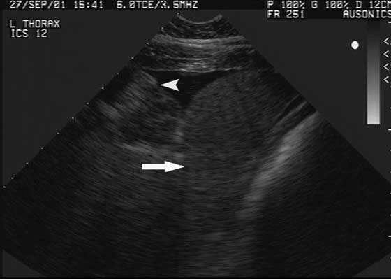Sonogram of a horse with a diaphragmatic hernia obtained from the left 12th intercostal space.