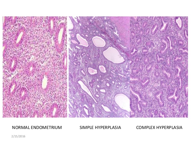 Image result for normal endometrium vs hyperplasia histopathology