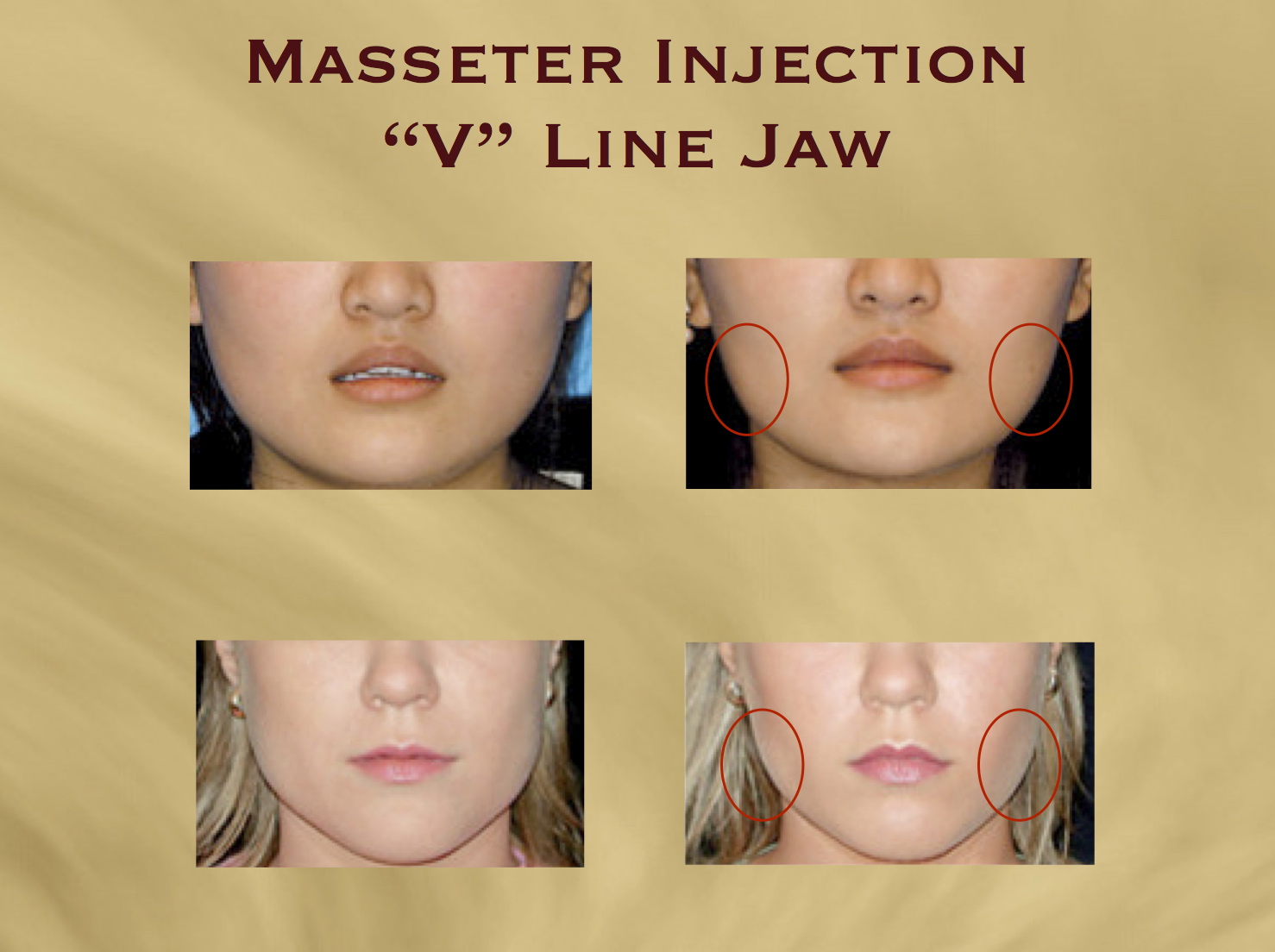 How Much Is Botox For Tmj