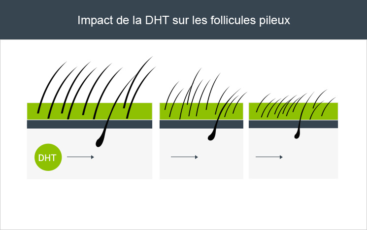 Impact DHT sur follicule pileux