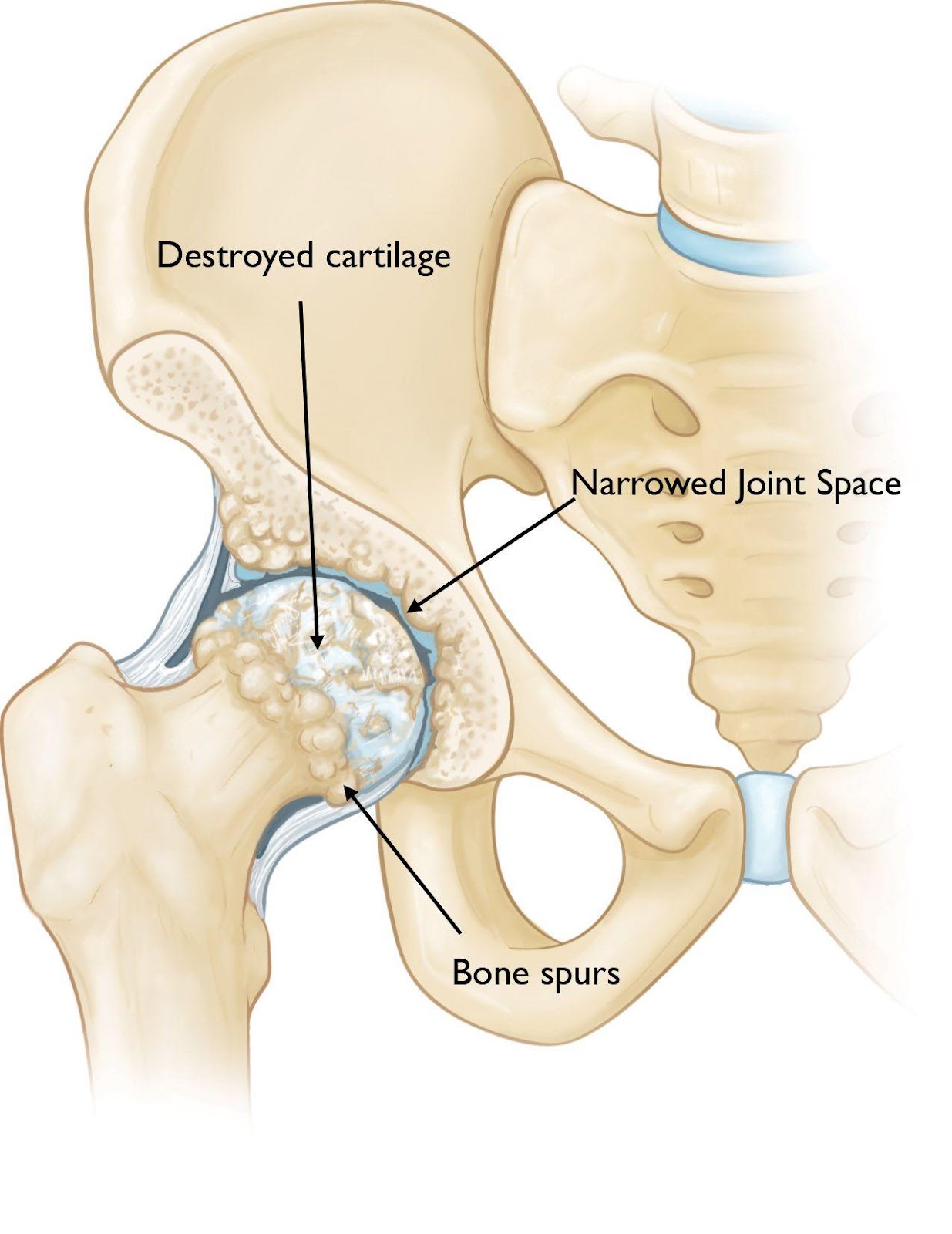 Types and Causes of Hip Arthritis