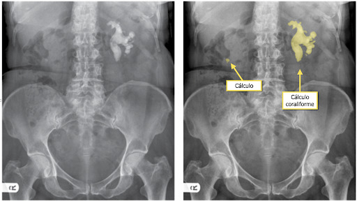 Radiografia de abdome em decúbito dorsal demonstrando cálculo coraliforme no rim esquerdo e cálculo calicinal no rim direito. (raio-x de abdome)