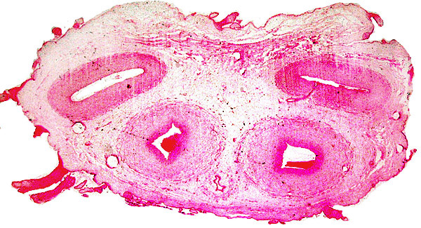 Umbilical cord with numerous foci of surface keratin accumulations and allantoic duct at center bottom