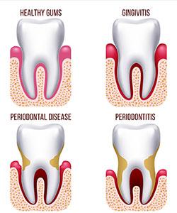 Gum Disease - Desert Sun Dental | Quincy WA