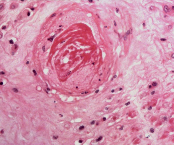 Spiral arteriole in Kolb's monkey decidua basalis showing partial thrombosis and an alteration of the wall referred to as 'atherosis'. This is an accumulation of cholesterol-laden macrophages in endothelial and muscular layers