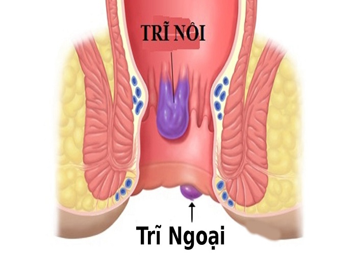 Phân biệt trĩ nội và trĩ ngoại