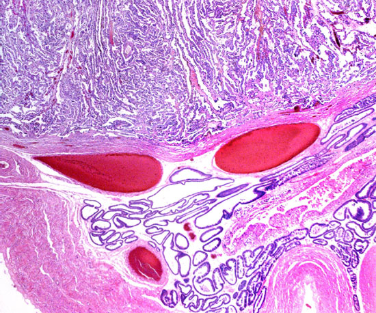 Implantation site of urial twin placenta. Bottom is myometrium, above are endometrial glands