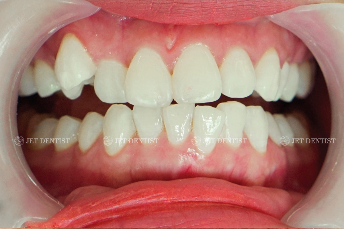BỌC SỨ RĂNG CỬA - BÍ QUYẾT ĐỂ SỞ HỮU NỤ CƯỜI TỰ TIN