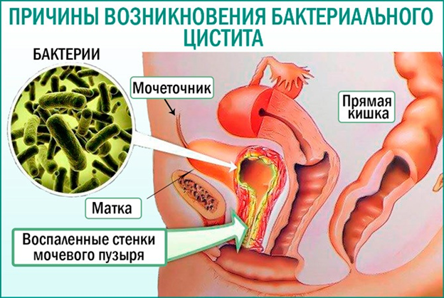 Инфекционный цистит у женщин. Бактерии причины цистита. Кишечная палочка вызывающая цистит.