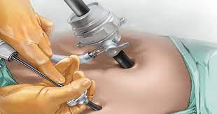 Role of Laparoscopy or Hysteroscopy in IVF Treatment