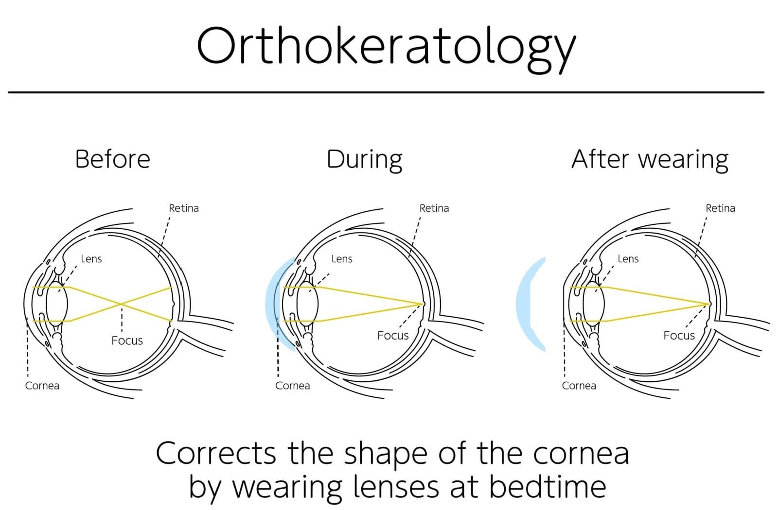 A diagram showing how ortho-k lenses can correct the shape of the cornea over time by wearing the lenses at bedtime