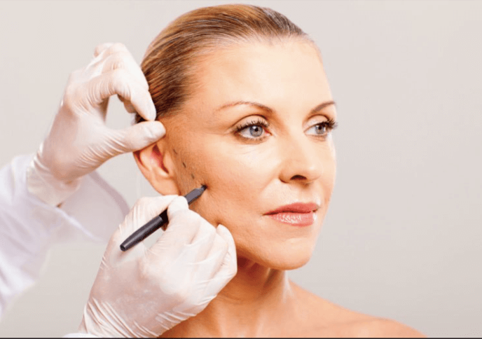 Căng da mặt bằng chỉ thường sử dụng chỉ collagen sinh học để cấy vào da mặt bị nheo nheo, chảy xệ. 