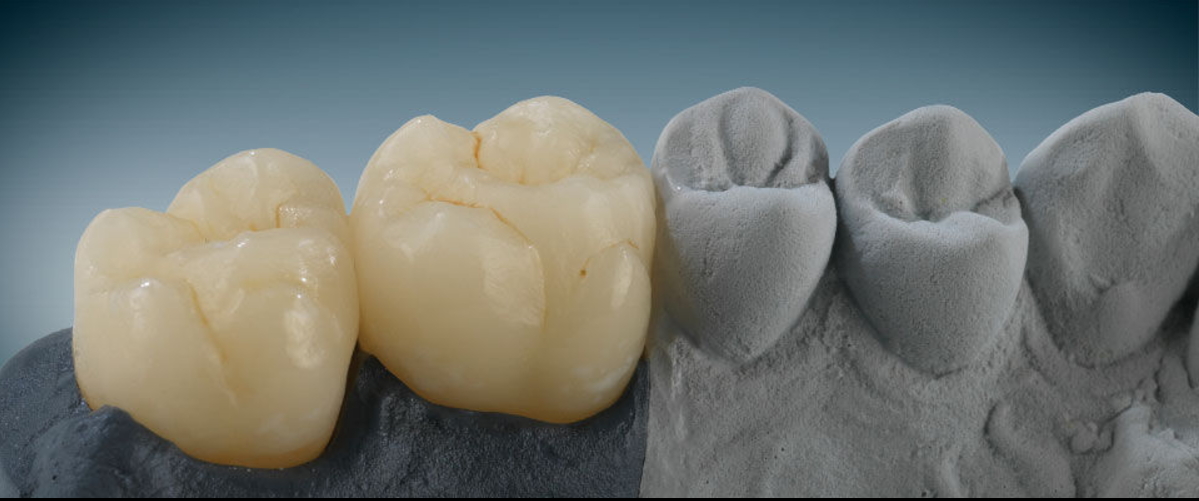 Replacing An Old Nhs Crown With An Implant And Porcelain Bridge
