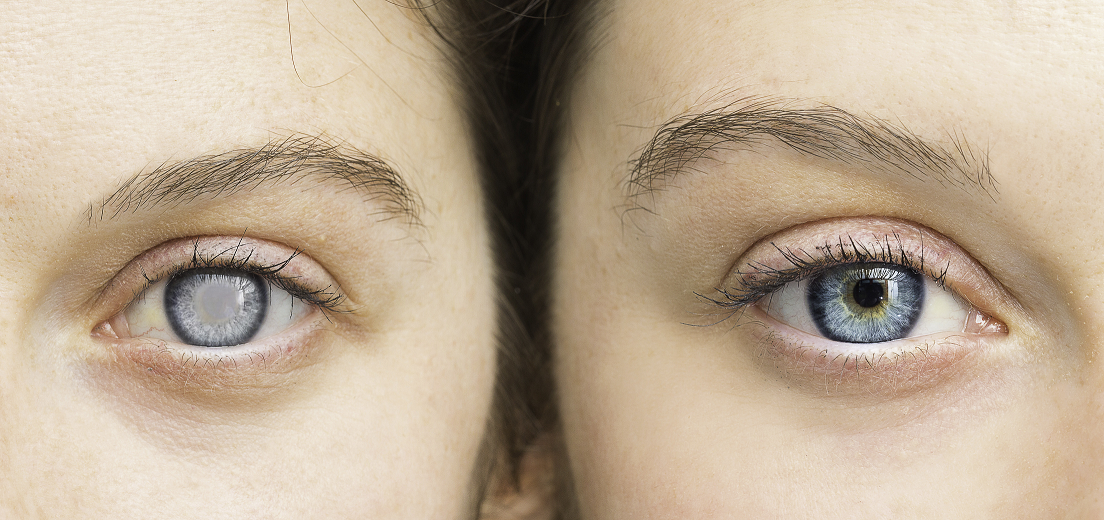 Glaucoma occurs when increased pressure in the eye destroys the optic nerve causing vision loss. 