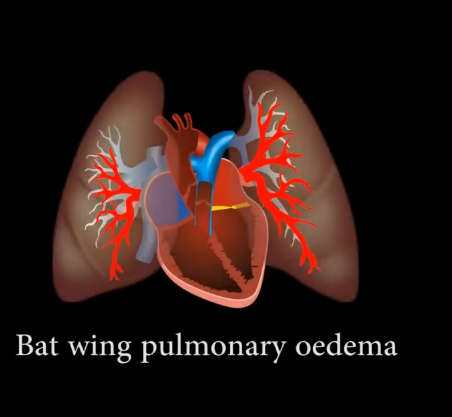 Bat wing pulmonary oedema