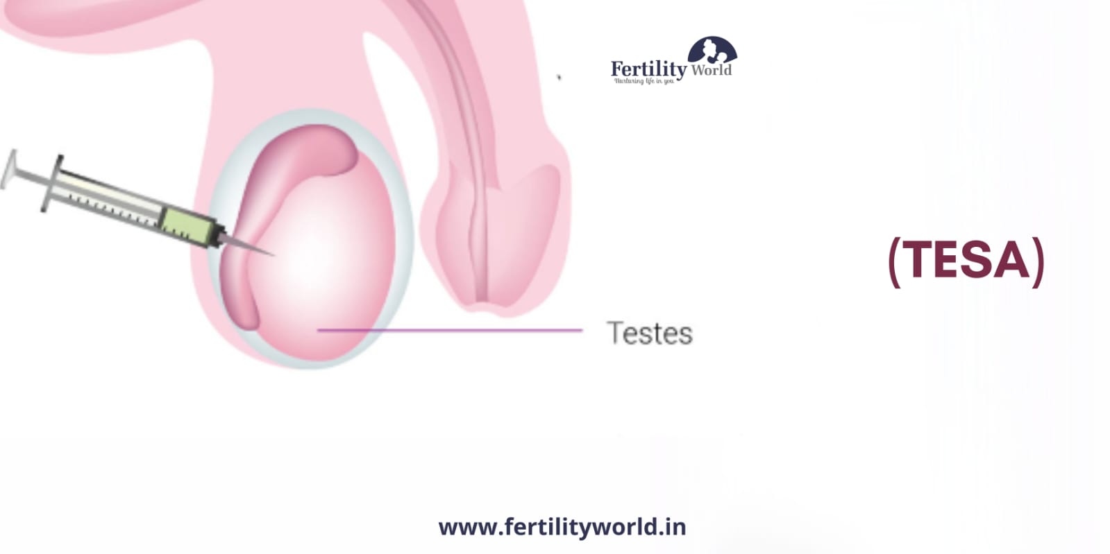 Testicular Sperm Aspiration (TESA) in the Philippines