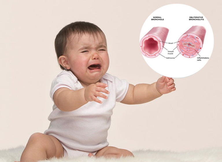 Các biểu hiện viêm phế quản ở bé 