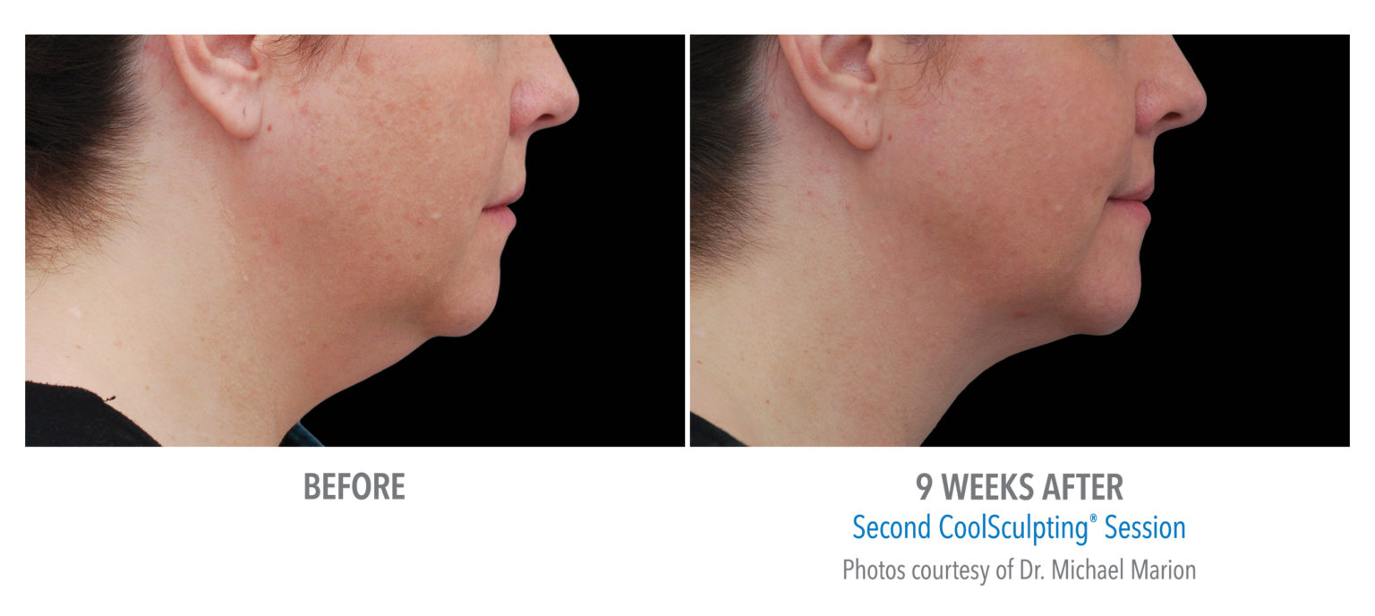 coolsculpting chin before and after picture