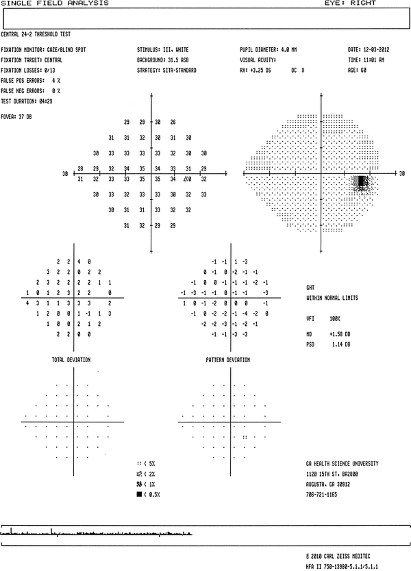  בתרשים מספר 3, ניתן לראות כיצד מתקבלת תוצאת הבדיקה כאשר שדה הראייה תקין. מקבץ הנקודות השחורות מסמן את הכתם העיוור, שהוא למעשה עצב הראייה, המופיע בבדיקה זו בצורה תקינה.