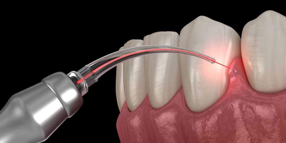 LANAP: The Minimally Invasive Laser Gum Disease Treatment | dramalfitano