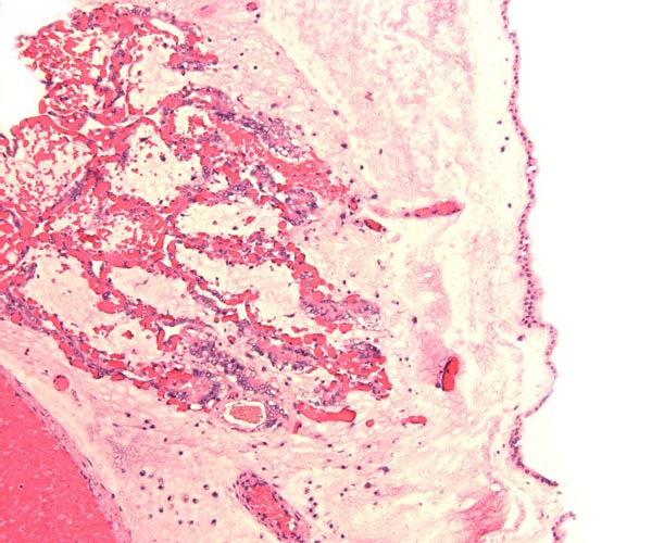 Thin villous placenta at left shows the congested fetal capillaries that come from the chorionic surface at the right. The surface epithelium is allantoic
