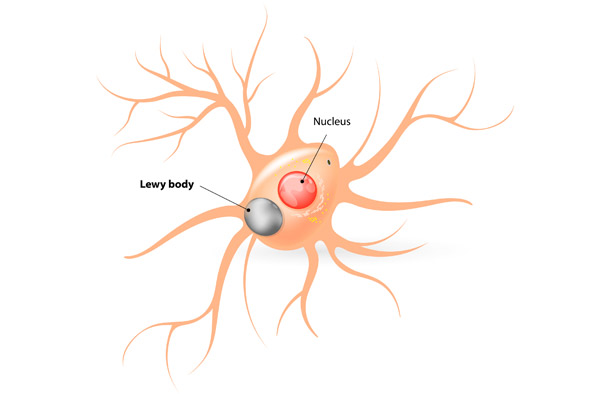 What is Lewy Body Dementia? - Balance