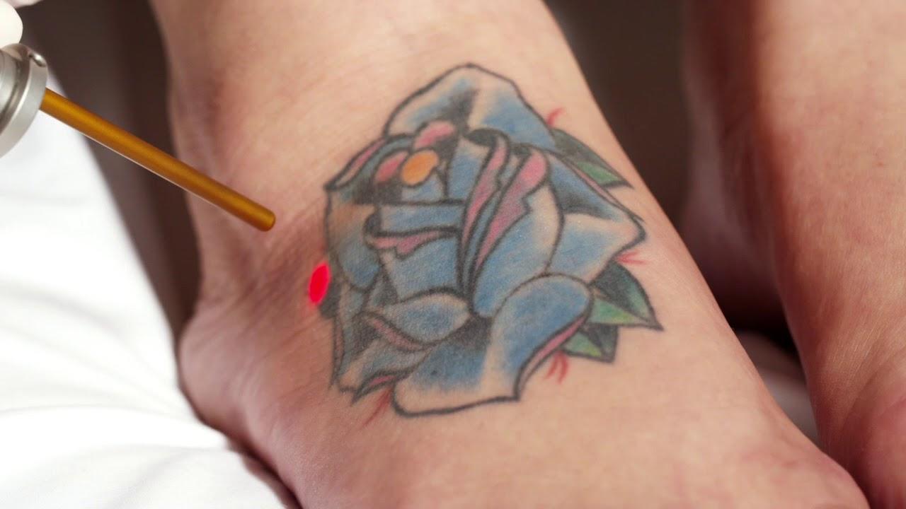 Astanza Eternity Ruby Tattoo Removal Laser System - YouTube