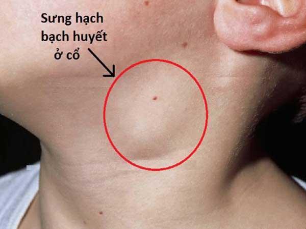 Nổi hạch tại vùng cổ là bệnh gì?