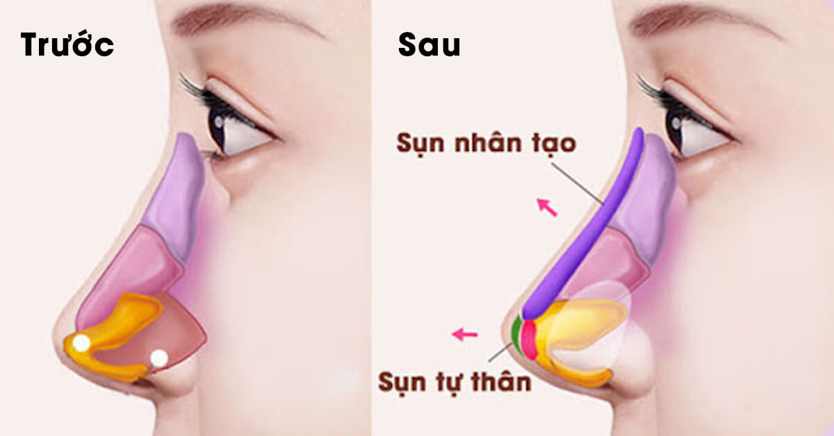 Nâng mũi Hàn Quốc được thuật hiện bằng cách, bác sĩ sử dụng sụn sinh học cao cấp giúp nâng cao phần sống mũi, làm sống mũi trở nên cao đjep, thon và vô cùng thanh tú.