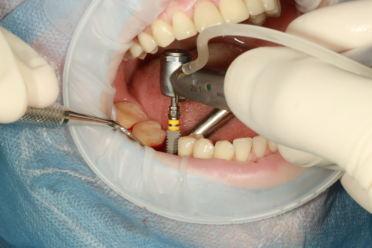 photo of the actual installing of the dental implant titanium post into the jaw