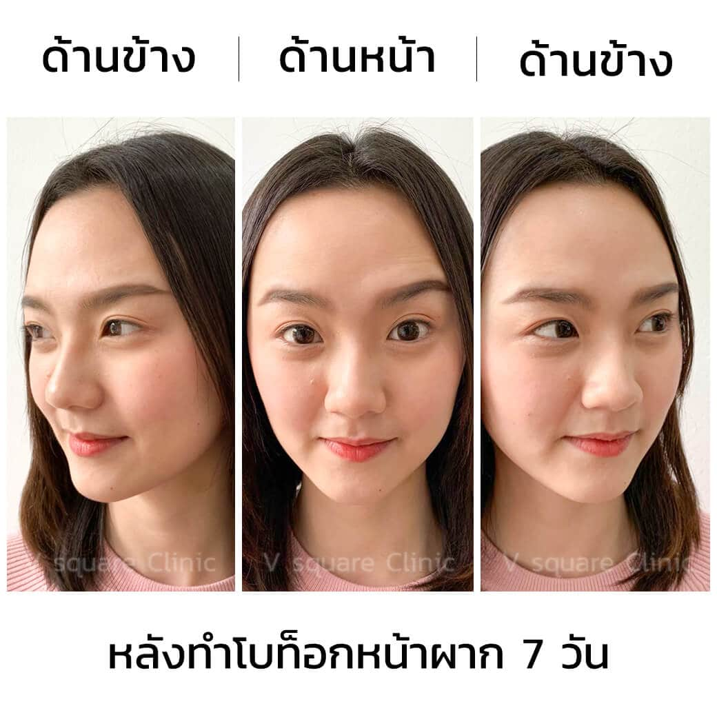 รีวิวโบท็อกหน้าผาก
