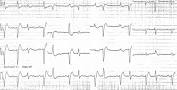 Image result for arrhythmia ecg examples